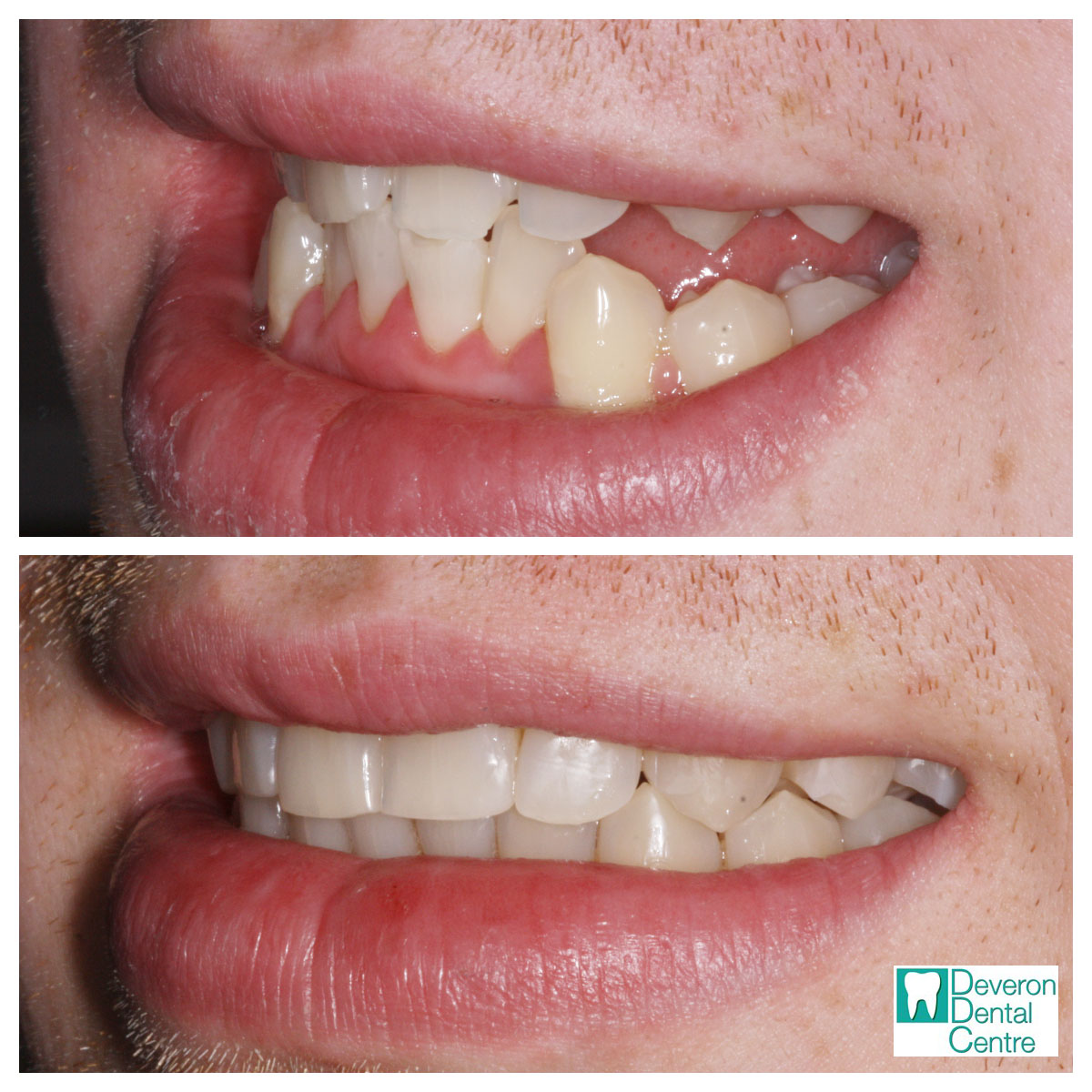 Invisalign Before and After Photo's Deveron Dental Centre Huntly