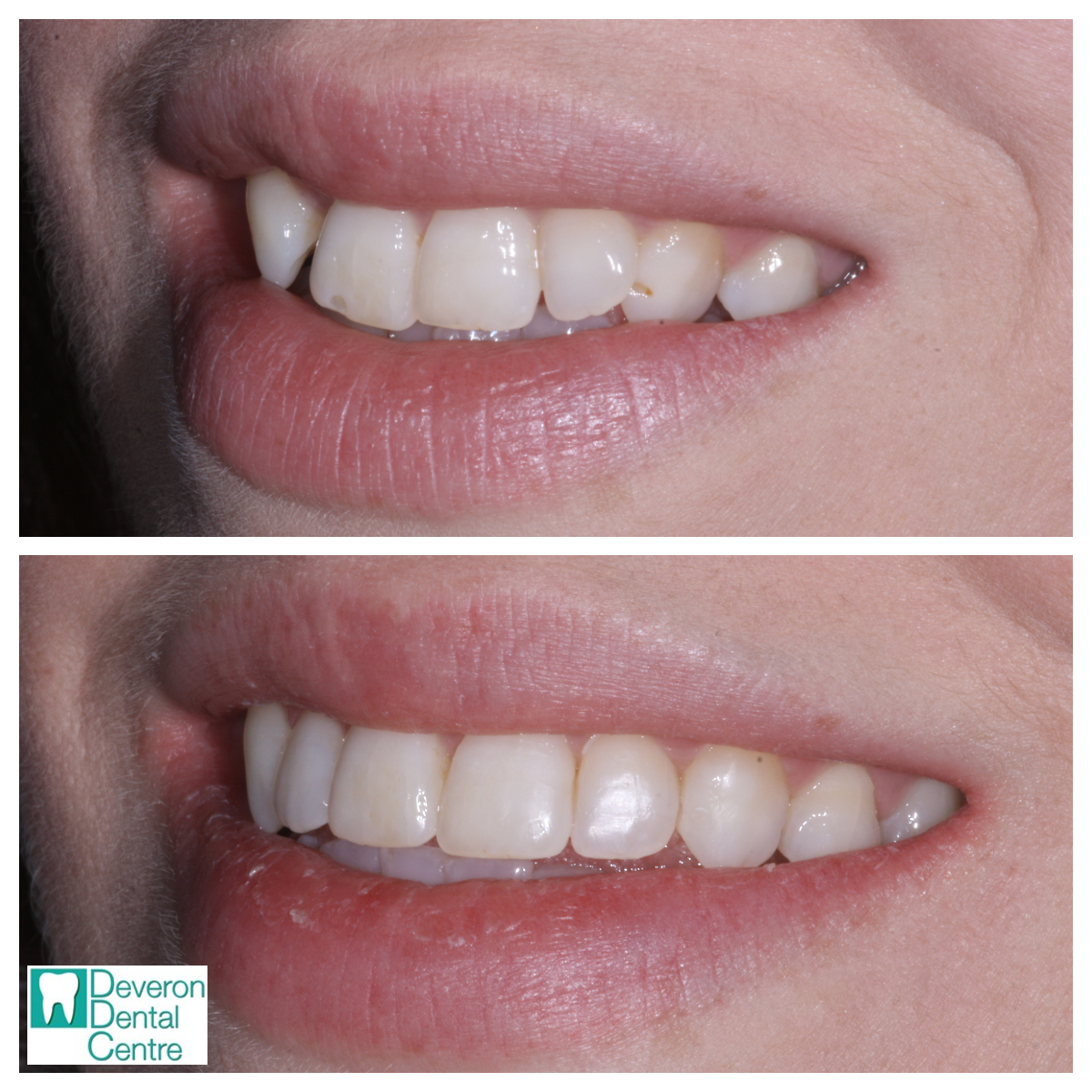 Invisalign Photos Before and After Deveron Dental Centre Huntly