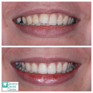 Invisalign Before and After - Chloe's Smile