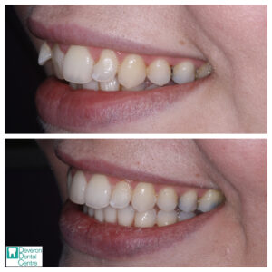 Invisalign Patient Stories - Patient 1 - Smile Left
