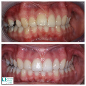 Invisalign Before and After - Chloe - Front