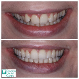 Invisalign Patient Stories - Patient 1 - Smile