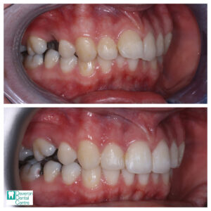 Invisalign Before and After - Chloe - Right