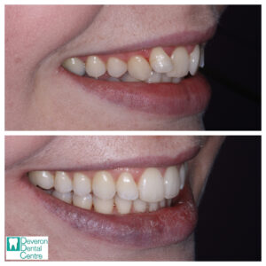 3 LM Invisalign Patient Stories - Patient 1 - Smile Right
