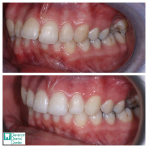 Invisalign Before and After - Chloe - Left