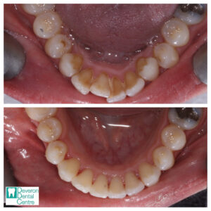 Invisalign Patient Stories - Patient 1 - Lower