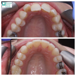 Invisalign Patient Stories - Patient 1 - Upper