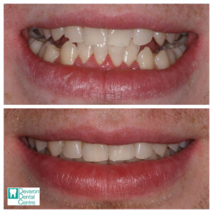 Invisalign Patient Stories - CS - Smile