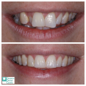 Invisalign Patient Stories - Patient DD - Smile