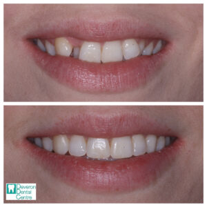 KB - smile from front