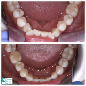 1 KD KD - Teeth - lower