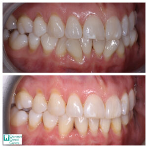 3 KD KD - Teeth - Right