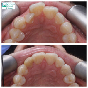 4 DD DD - Teeth - Upper