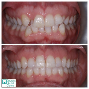 4 KB KB - Teeth front