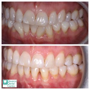 4 KD KD - Teeth - Left
