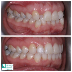 5 KB KB - Teeth Right