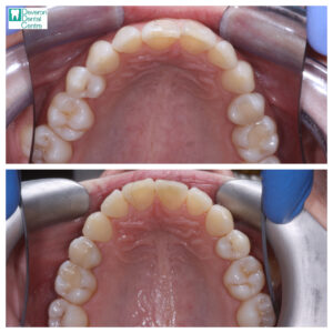 5 KD KD - Teeth - Top