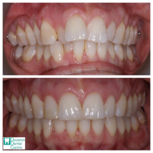 6 DD DD - Teeth - Front