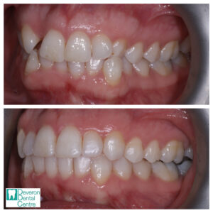 6 KB KB - Teeth - Left