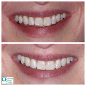 Invisalign Patient Stories - Patient 1 - Smile