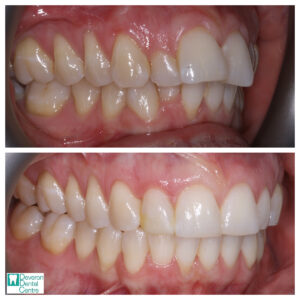 7 DD DD - Teeth - Right