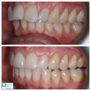 8 DD DD - Teeth - Left