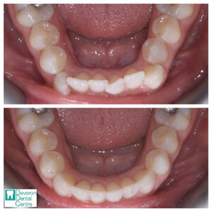 8 KB KB - Bottom Teeth