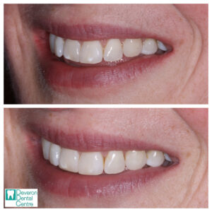 8 KD KD - Smile - Left